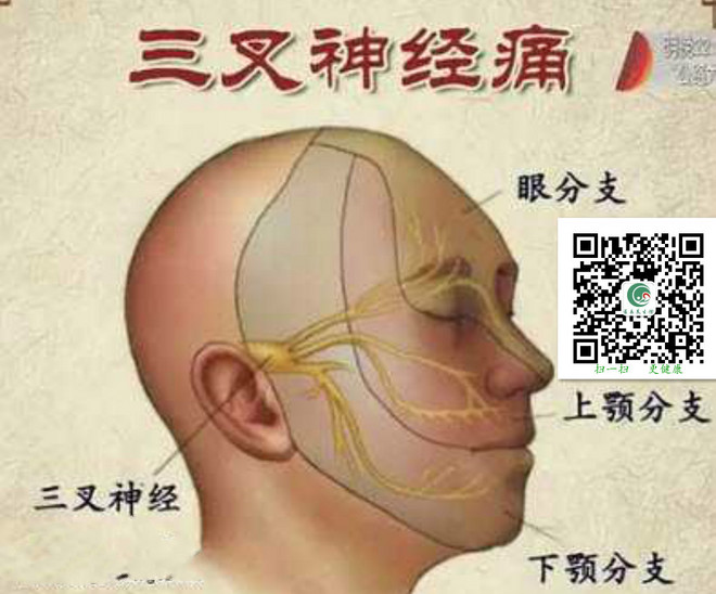 1479602915926820.jpg 三叉神经痛.jpg